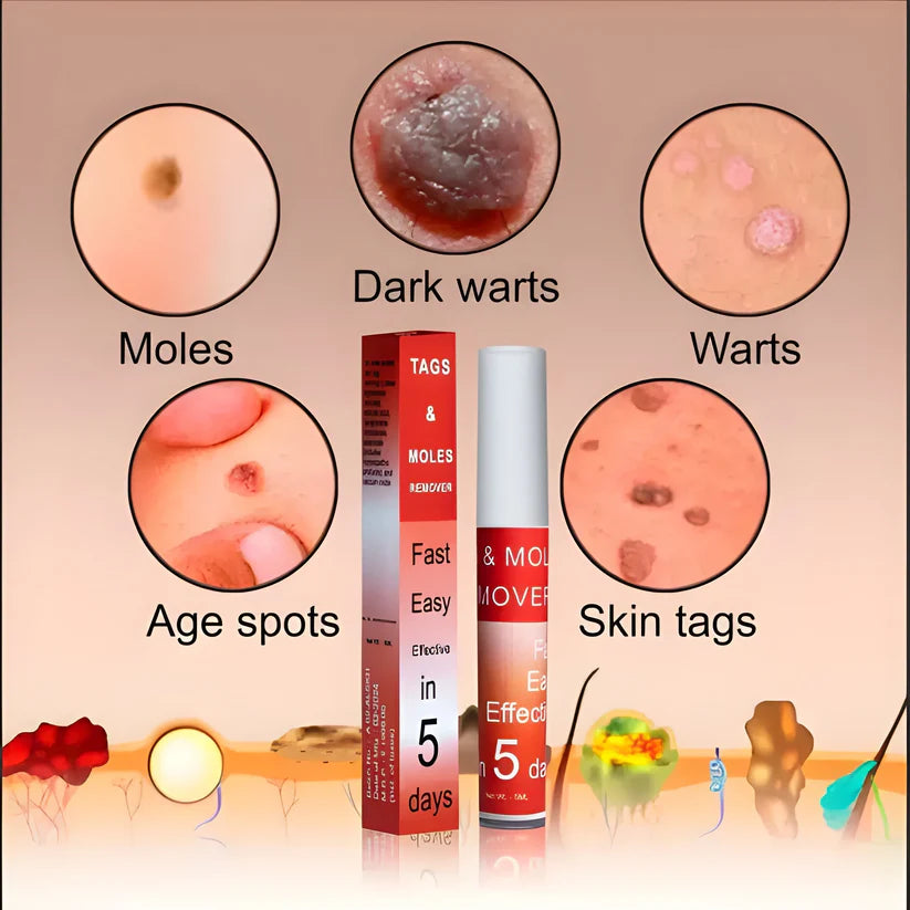 Skin Tag Remover Cream