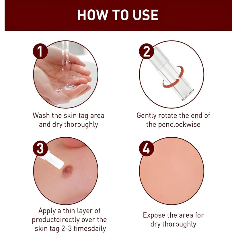 Skin Tag Remover Cream