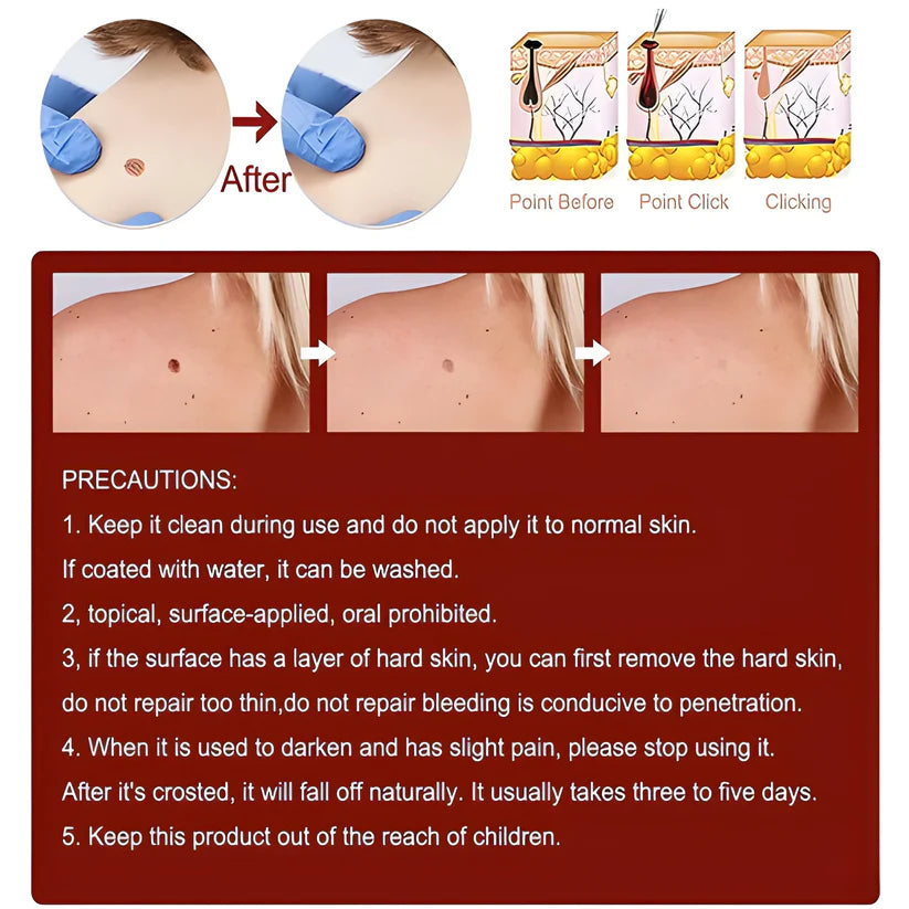 Skin Tag Remover Cream