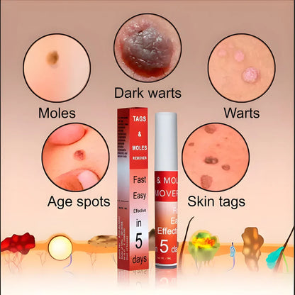Skin Tag Remover Cream
