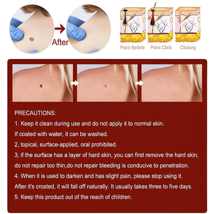 Skin Tag Remover Cream
